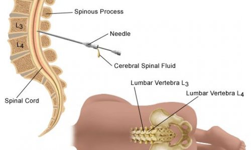 sclerosi e proteina rab32